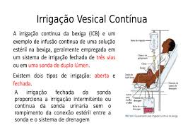 Irrigação vesical PE3 - Enfermagem